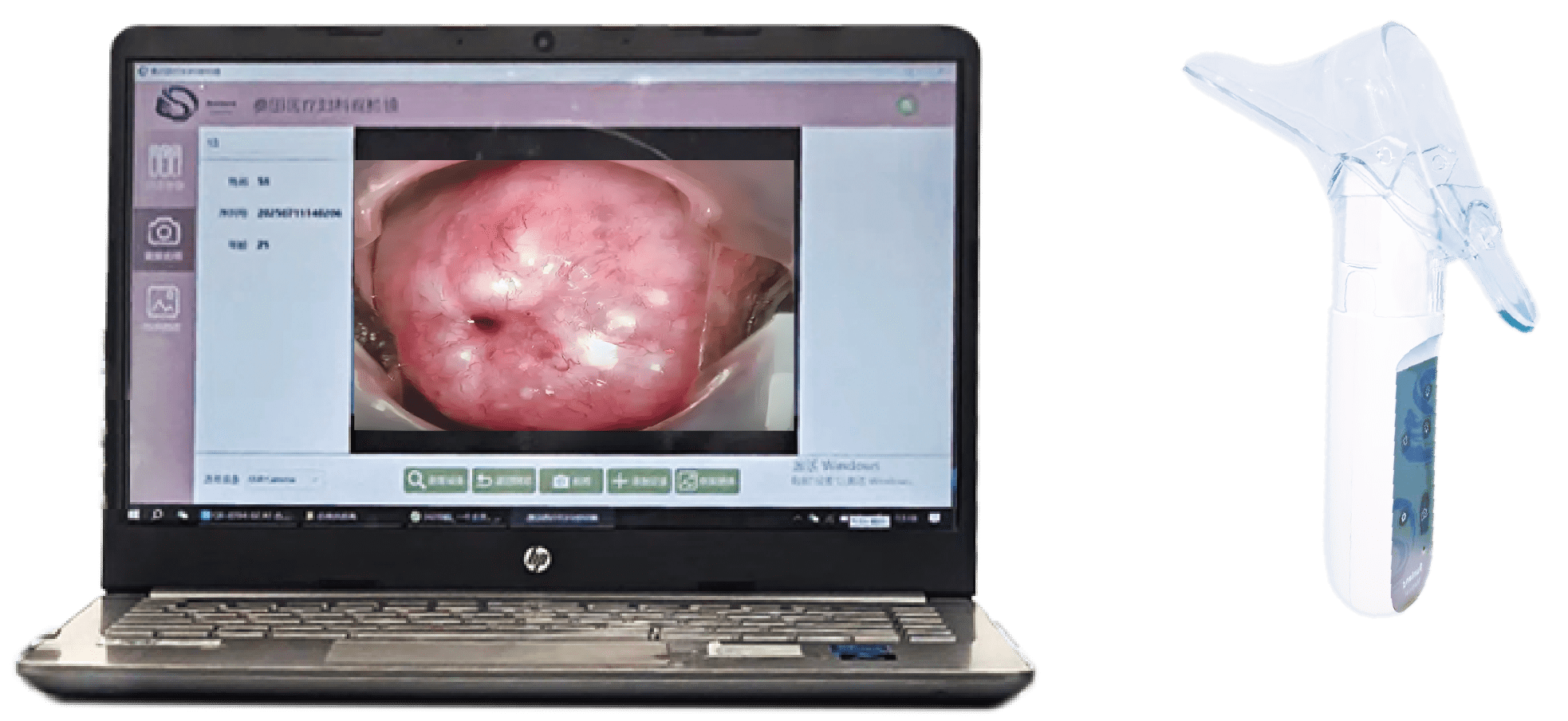 Portable Electronic Colposcope